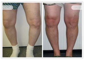Before & After Joint Surgery