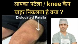 how to treat knee cap or patella dislocation #patella #patelladislocation