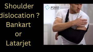 Shoulder dislocation problem which is better Latarjet or Bankart arthroscopic repair