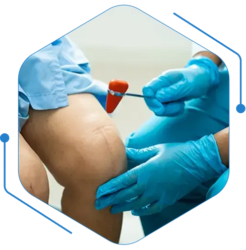 PCL-Surgery-image.webp