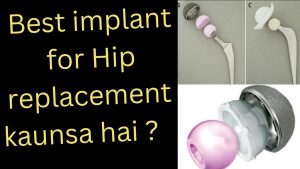 Kaunsa Jyada Chalega – The Best Hip Replacement Implant Ceramic On Poly Or Ceramic On Ceramic