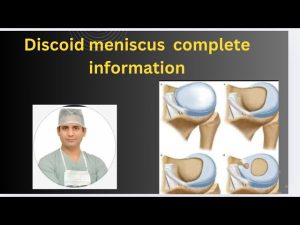 Complete information about discoid meniscus treatment / meniscus repair