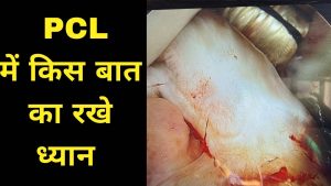 PCL लिगामेंट का ईलाज में क्या बात ध्यान रखना है ?